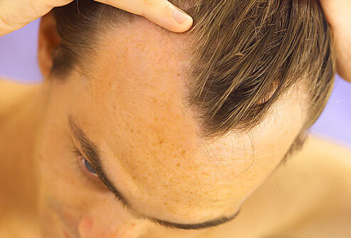 hair_scalp_s8_male_hair_loss